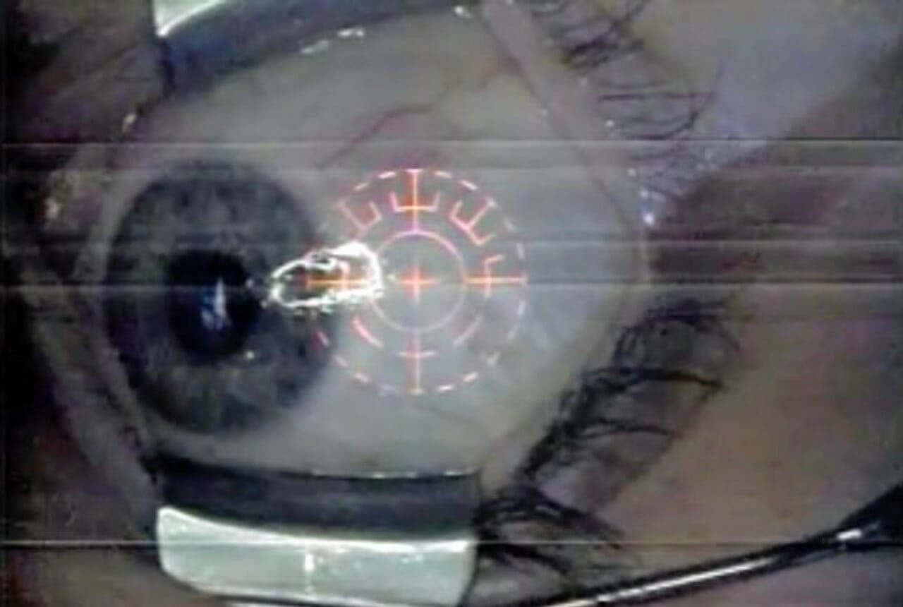 surgically implanted eye jewelry