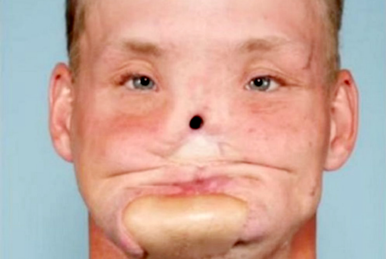 face transplant surgery